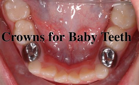 Crowns For Baby Teeth