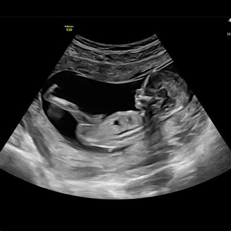 13 Week Ultrasound Pictures