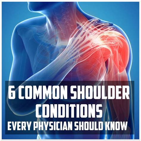 Common Shoulder Conditions Every Physician Should Know Sports