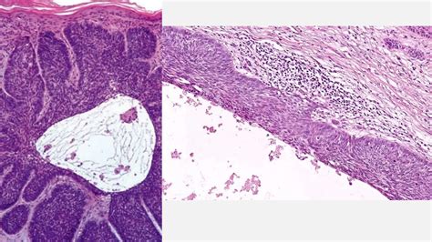 Carcinoma Basocelular Espinocelular Y Su Tratamiento Ppt