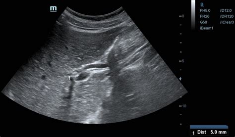 Common Hepatic Duct Ultrasound