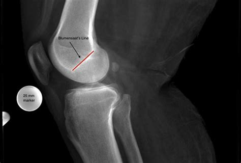 Lateral Knee Radiograph