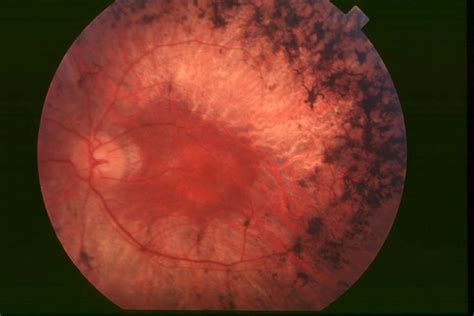 Retinosis pigmentaria Consulta de Oftalmología Pediátrica Dr