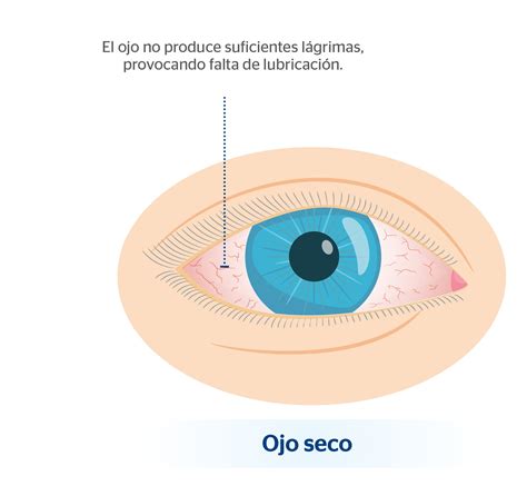 Descubre las causas detrás del parpadeo constante en los ojos