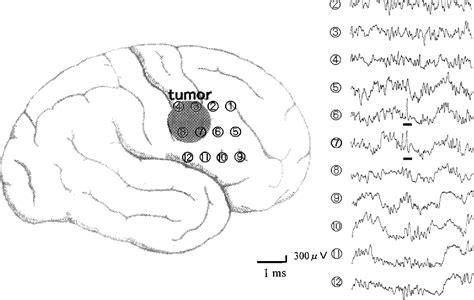 Figure 3 From Ictal Brain Hemodynamics In The Epileptic Focus Caused By