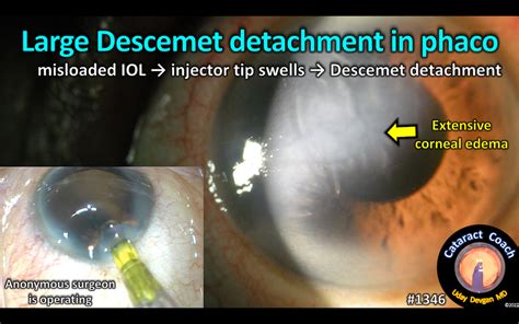 1346 Large Descemet Detachment Cataract Coach™