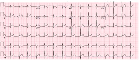 Myocarditis Ecg Changes