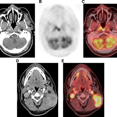 A Year Old Male Patient Presented With Pathologically Proven