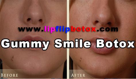 Gummy Smile Botox - Lip Flip Botox