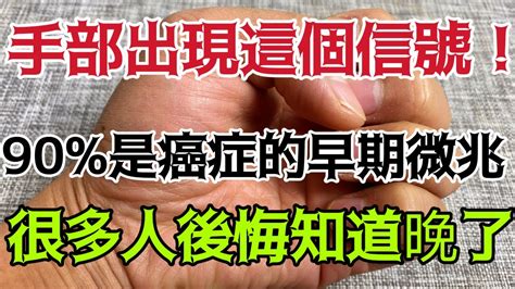 癌症專家提醒：體內有癌手指先知！手指上若出現這個信號，90癌症已經纏上你了！千萬不要忽視！ ！ ！ Youtube