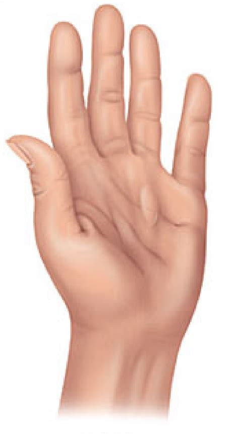 Dupuytrens Contracture Causes Symptoms And Treatments Hand Wrist