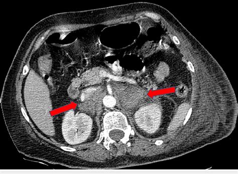 CT Scan Confirms Bilateral Adrenal Hemorrhage Adrenal Congestion With