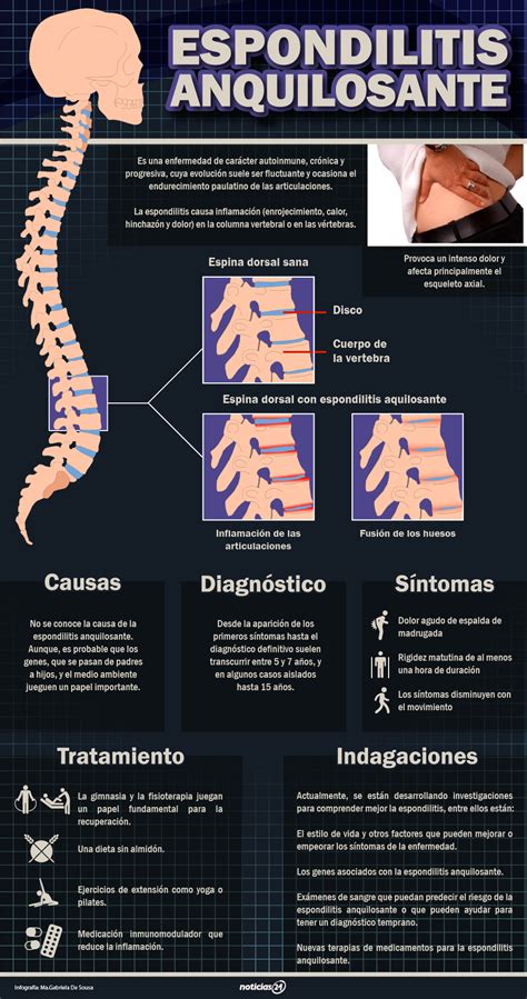 O Que Espondilite Anquilosante Espondilite Anquilosante Espondilite