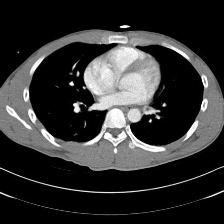 Liver laceration - AAST grade V | Radiology Case | Radiopaedia.org