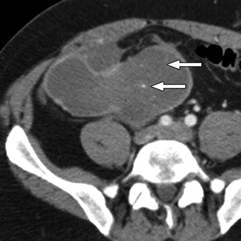 Ultrasound Imaging Of Bowel Pathology Technique And Keys To Diagnosis