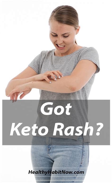 Got Keto Rash Heres What It Is And What To Do Healthy Habit Now