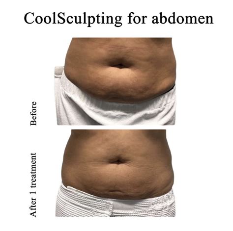 Coolsculpting Chicago Fat Reduction Natural Beauty Med Spa