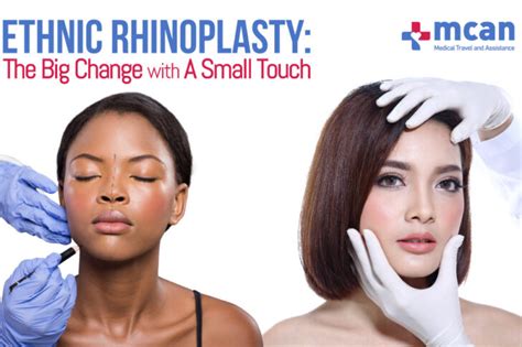 Best Ethnic Rhinoplasty In Turkey To Get The Ideal Nose