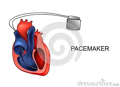 Heart And Pacemaker Cardiology Cartoon Vector Cartoondealer