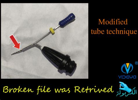 Using Modified Tube Technique To Retrieve A Broken File الكربولة