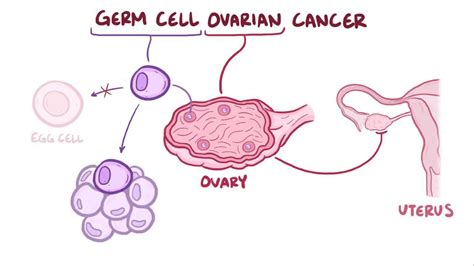 Video: Germ cell ovarian tumor