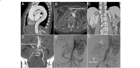 A Preoperative Sagittal Computed Tomography Angiography Showed Type B Download Scientific