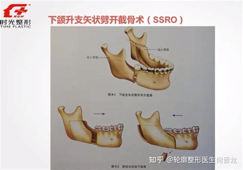 正颌手术有哪些术式正颌选择哪种术式呢 知乎