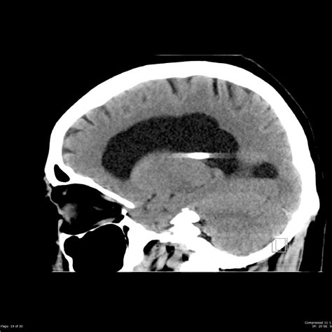 Normal Pressure Hydrocephalus Image Radiopaedia Org