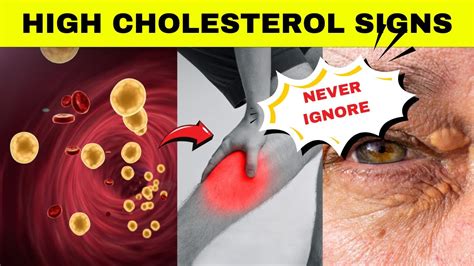 These Signs Tell You That You Have High Blood Cholesterol Warning