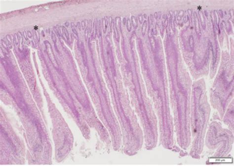 Identificación De Biomarcadores Potenciales Para El Fallo De La Barrera