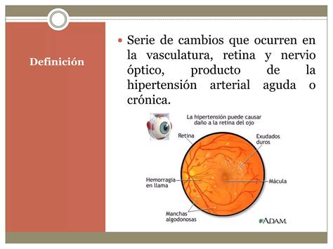 Retinopatia Hipertensiva PPT