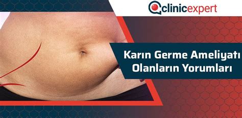 Karın Germe Ameliyatı Sonrası Yorumlar ClinicExpert