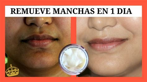 Arriba 82 Imagen Recetas Para Quitar Las Manchas Dela Cara Abzlocalmx