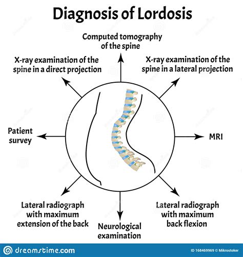 Diagnosi Della Lordosi Curvatura Spinale Cifosi Lordosi Scoliosi