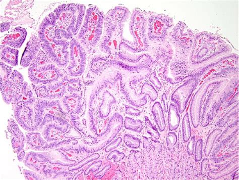 Rectal Polyp Histology