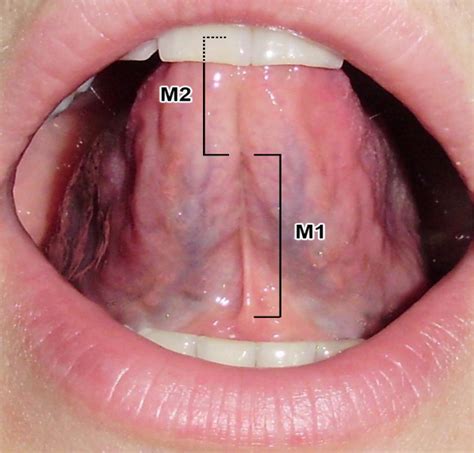 Anatomy Of Underside Of Tongue