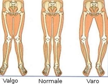 Il Ginocchio Valgo Si Pu Curare I Migliori Esercizi Correttivi