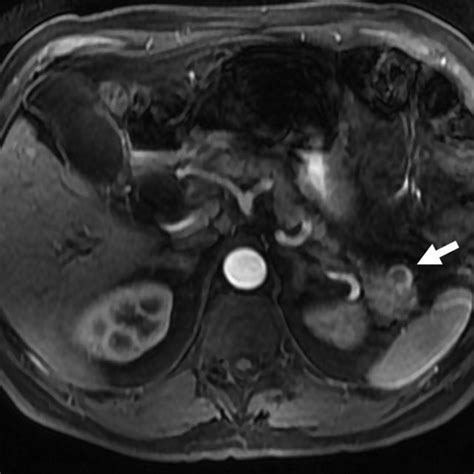 A Year Old Male With Incidental Cystic Pancreatic Neuroendocrine