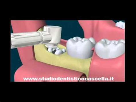 Studiodentisticocascella It Estrazione Del Dente Del Giudizio Con