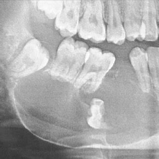 Orthopantomograph Shows A Welldefined Multilocular Radiolucency On The