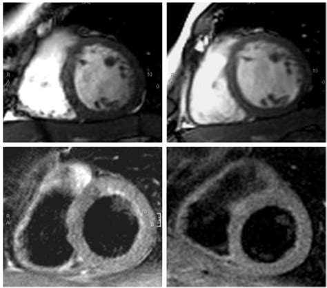 Cmr Images In The Acute Left And Convalescent Right Phase Of