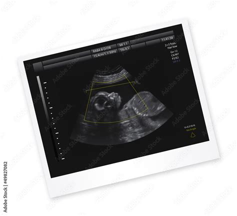 Ultrasound of baby in mother's womb. Stock Photo | Adobe Stock