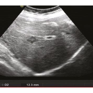 Ultrasound examination of breast cancer (http://alturl.com/g4og7 ...