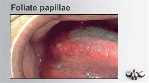 Common Oral Lesions2