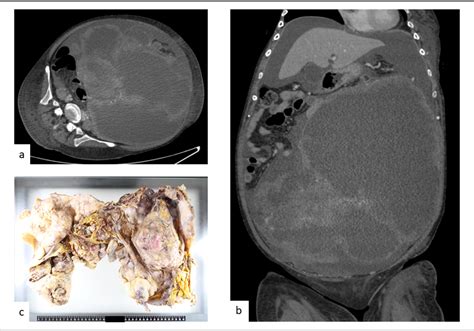 Figure 1 From A Case Of Malignant Phyllodes Tumor Of The Breast