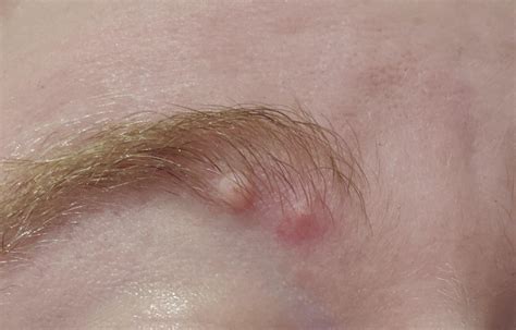 Anyone Know What These Bumps On My Eyebrow Are R Dermatologyquestions