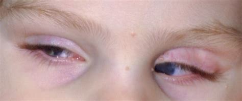 Bilateral Congenital Microphthalmia With Visual Acuity Dalpasso Protesi Oculari