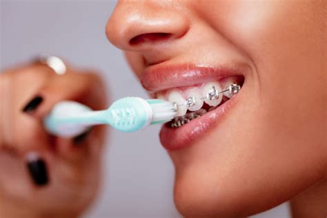 Preventing Cavities During Braces Belmar Orthodontics