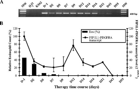 A Case Of Fip1l1 Pdgfra Positive Chronic Eosinophilic Leukemia With A