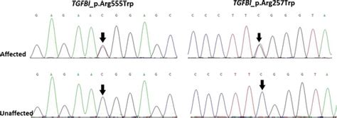 Dna Sequence Chromatograms Of The Proband Note The Heterozygous C T